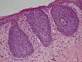 Carcinoma (epithelioma) basocellulare superficiale