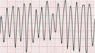 Flutter ventricolare: caratterizzato da onde ampie e sinusoidali con frequenze che oscillano fra i 150 e i 300 batt/min. Tale aritmia necessita di defibrillazione, poiché determina in tempi rapidi una sincope con collasso emodinamico.[57]