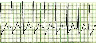 Tachicardia parossistica sopraventricolare: è un ritmo cardiaco ad alta frequenza, che origina al di sopra del ventricoli. Non sono visibili le onde P e la frequenza è in genere superiore ai 150 batt/min.